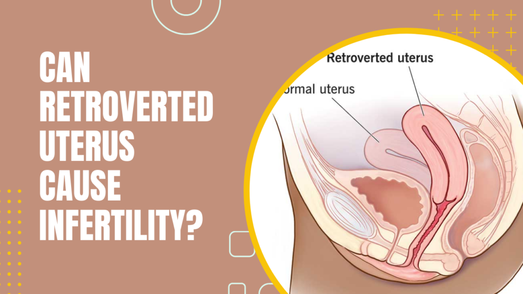 Can Retroverted Uterus Cause Infertility?